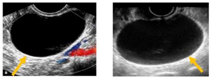Are blood filled ovarian cysts cancerous?
