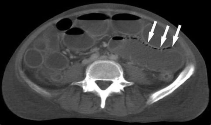 Are bowel obstructions hereditary?