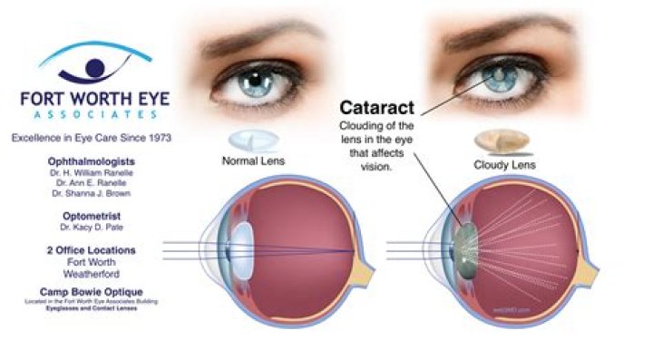 Are halos after cataract surgery?
