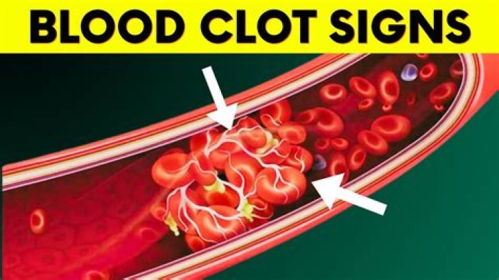 Can a blood clot kill you?
