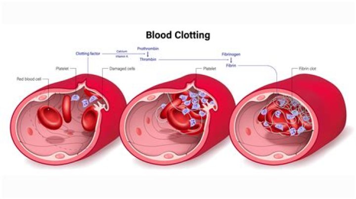 Can calquence cause blood clots?