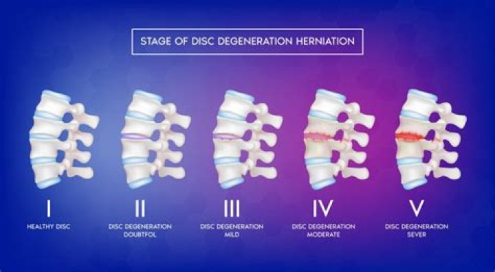Can disc desiccation be caused by trauma?