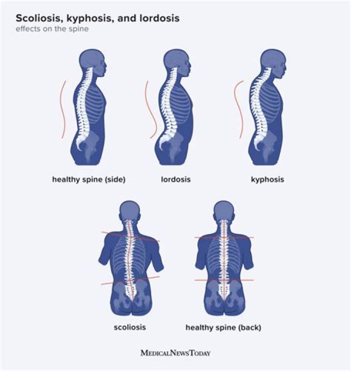 Can kyphoscoliosis kill you?