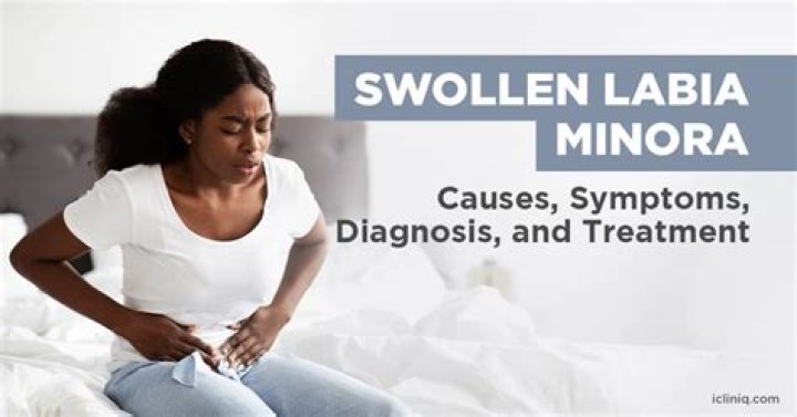 Can large labia minora cause infections?