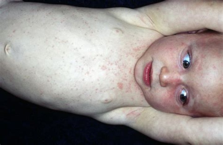 Can roseola rash be itchy?