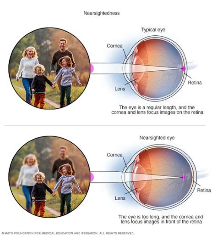 Can short sightedness get better?