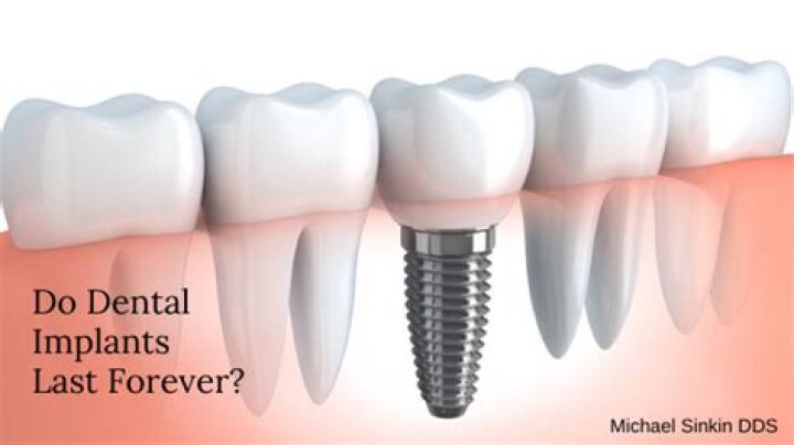 Do dental implants last forever?