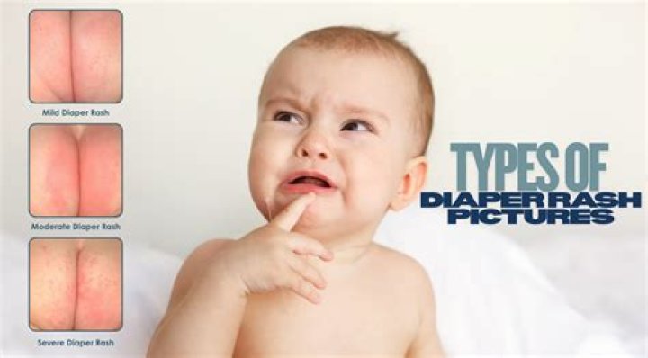 Do diapers cause rashes?