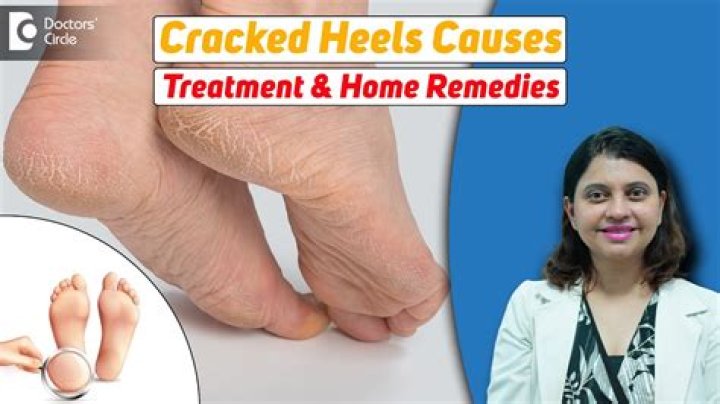 Do pedicures help cracked heels?