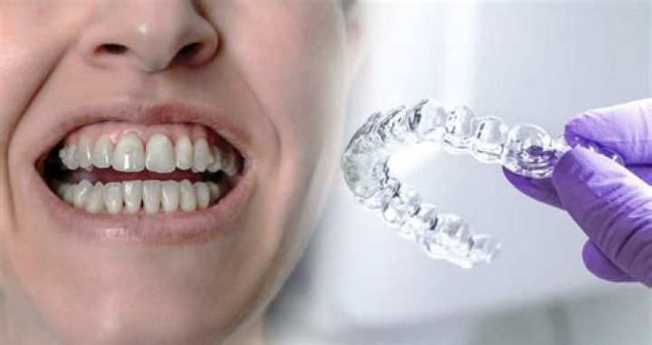 Does aligners really work?