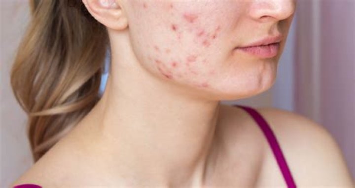 Does fragrance cause acne?