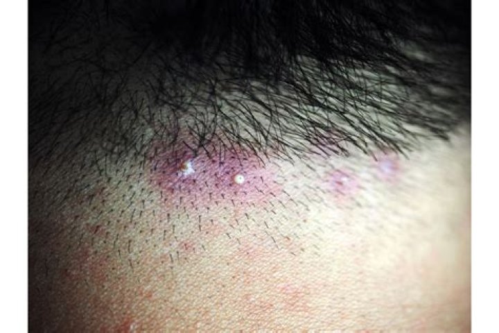 Does ingrown hair have pus?