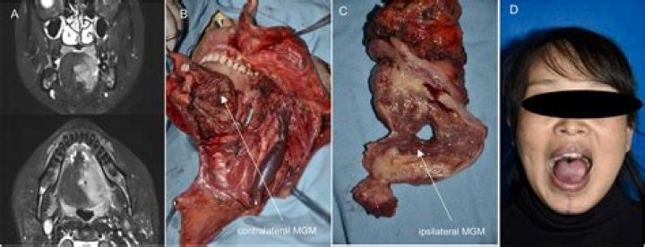 How long does glossectomy surgery take?