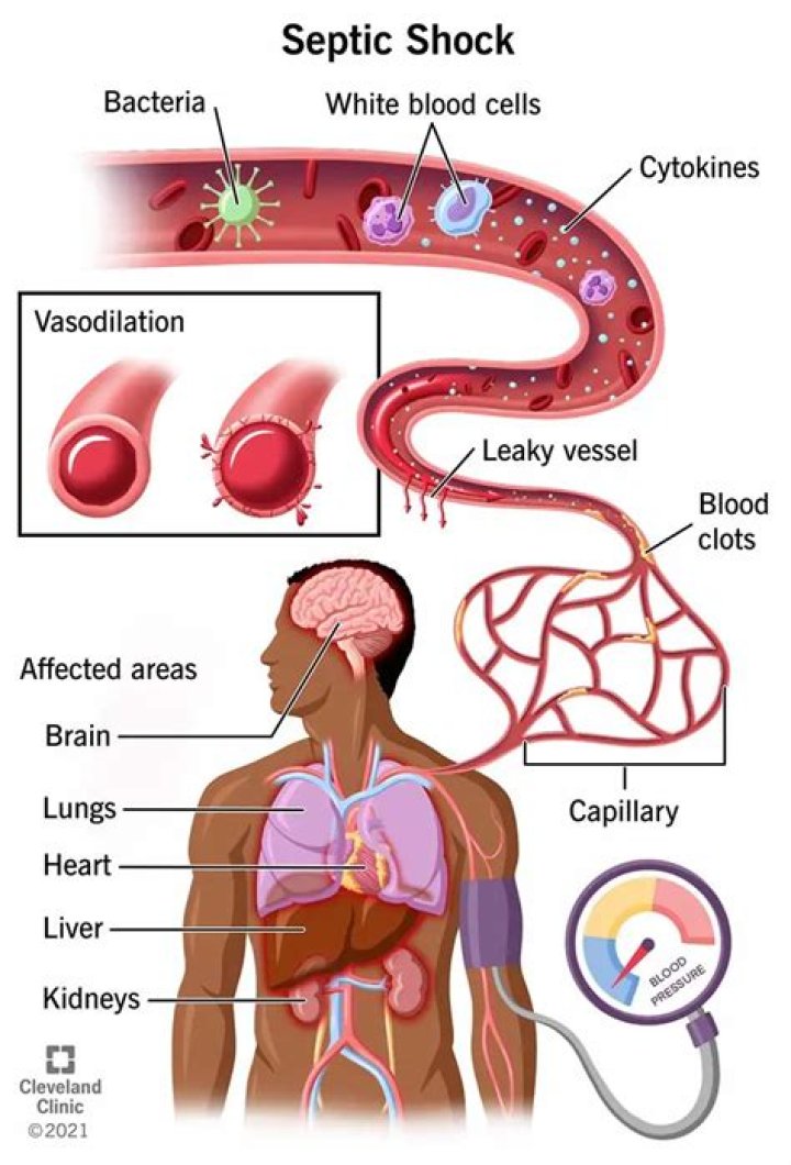 How septic shock occurs?