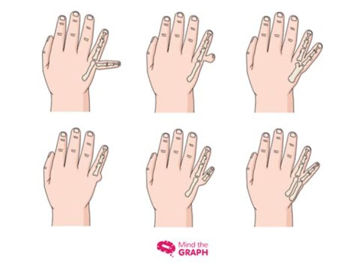 Is polydactyly caused by inbreeding?