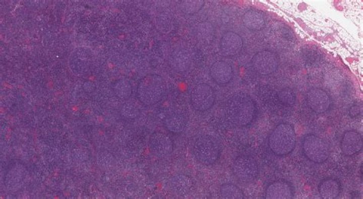 Is reactive lymphoid hyperplasia cancer?