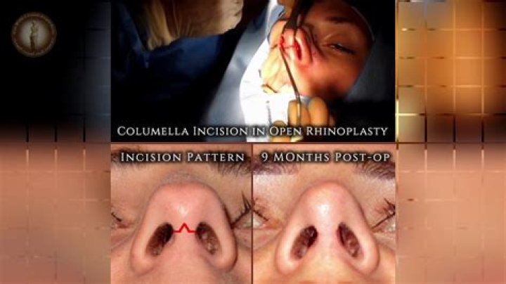 Is the columella swollen after rhinoplasty?