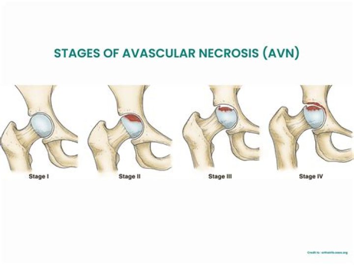 What are the stages of avascular necrosis?