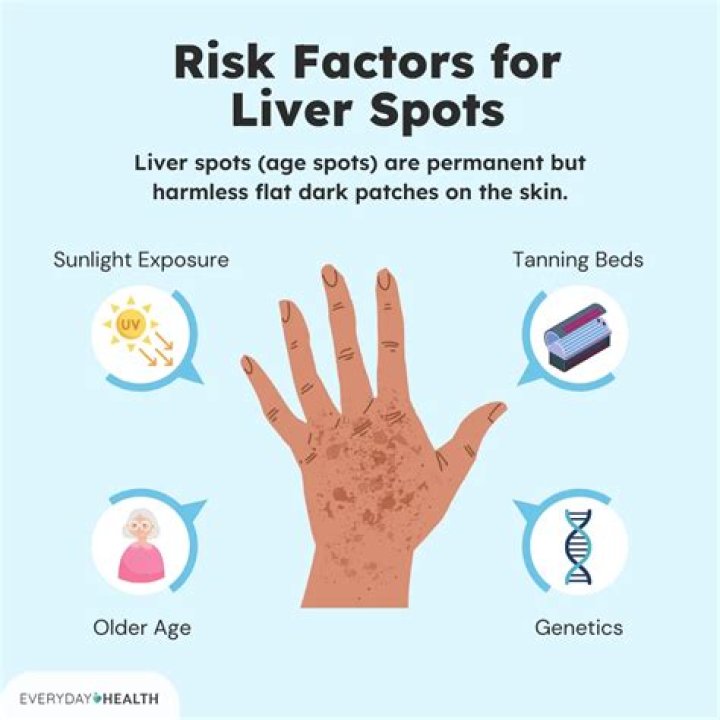 What causes white liver spots on skin?