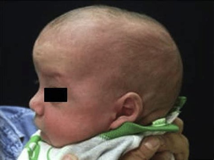 What does scaphocephaly mean?