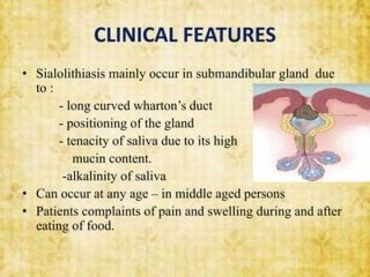 What is a sialolithiasis in medical terms?