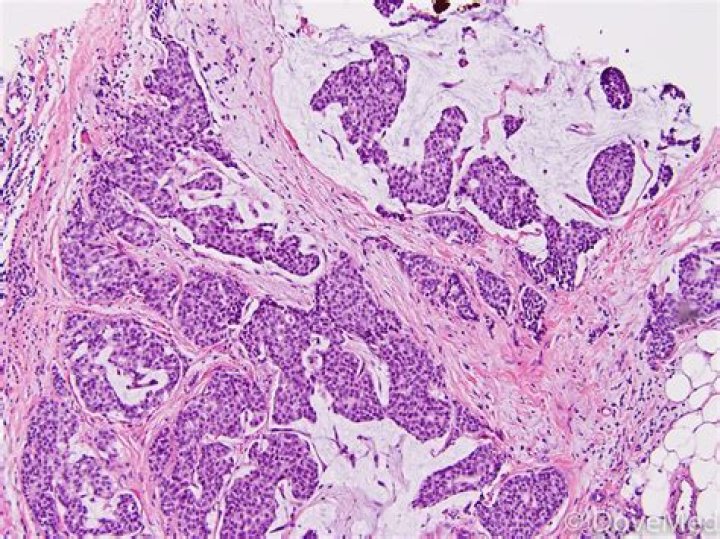 What is mucinous carcinoma?