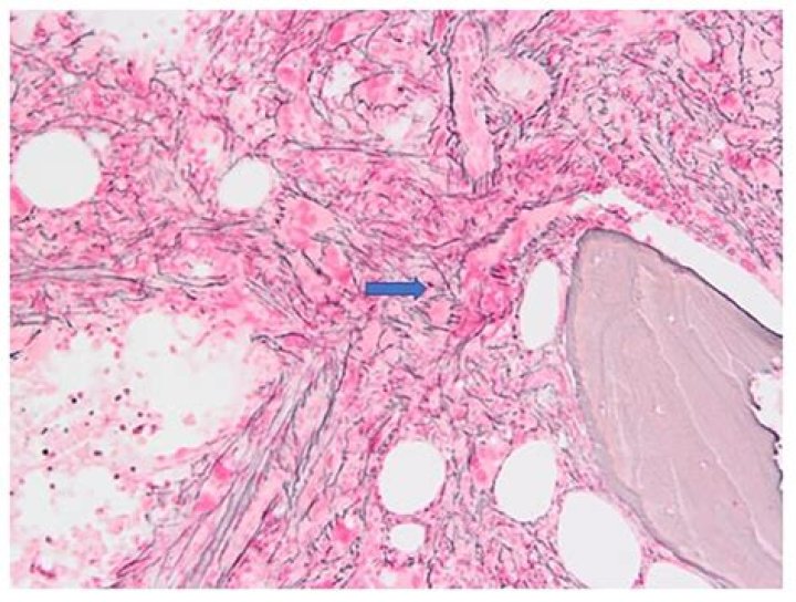 What is reticulin in bone marrow?