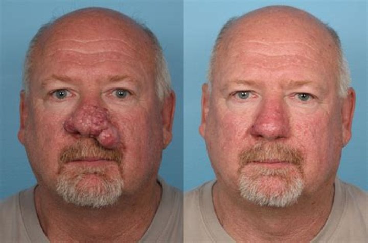 What is rhinophyma surgery?
