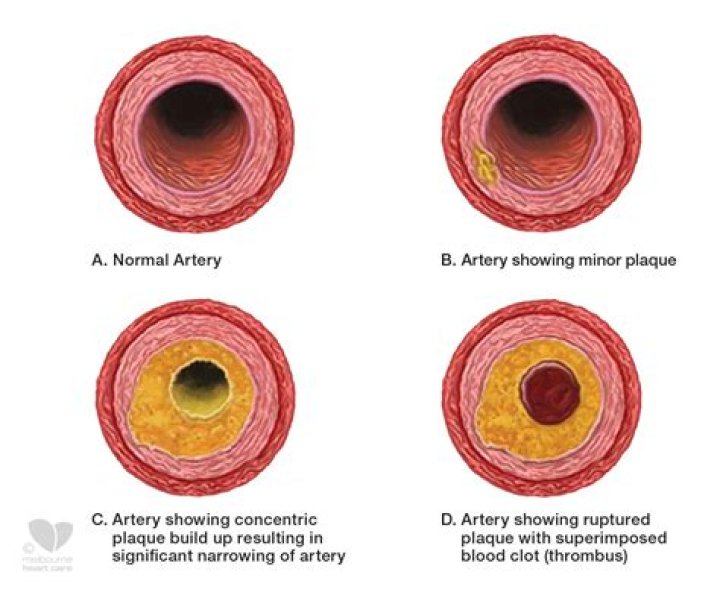 When does plaque build up in arteries?
