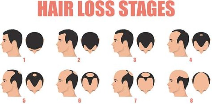 Where does balding begin?