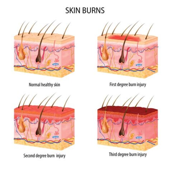 Where is second degree burns?