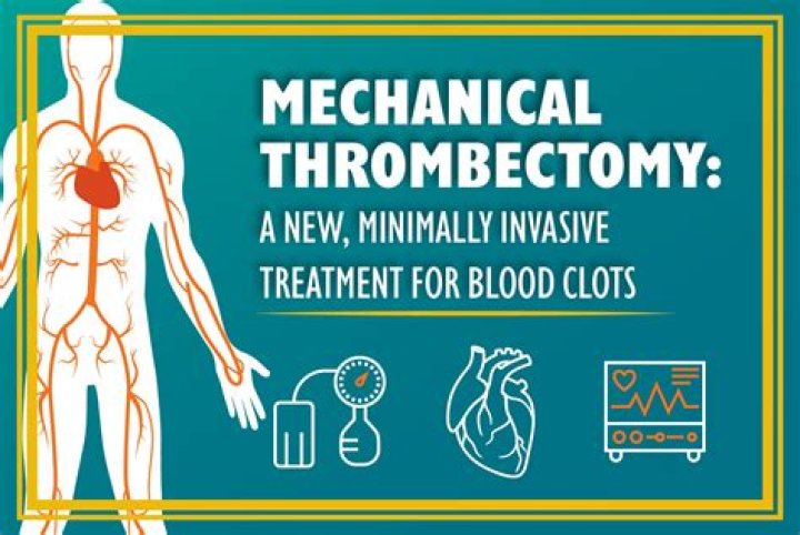 Who performs mechanical thrombectomy?