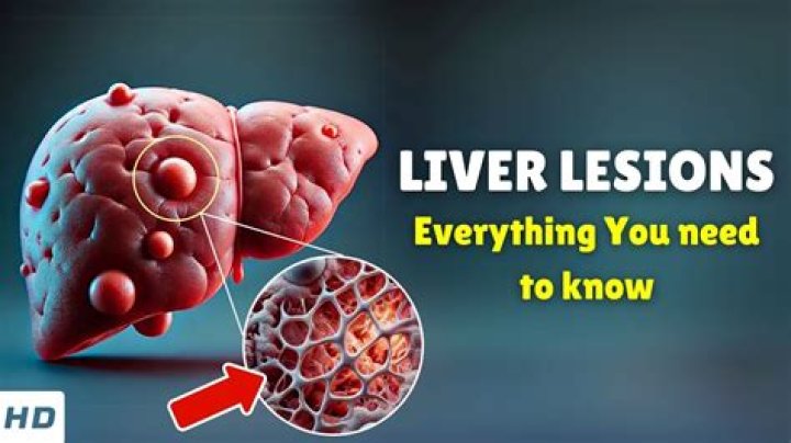 Who treats liver lesions?