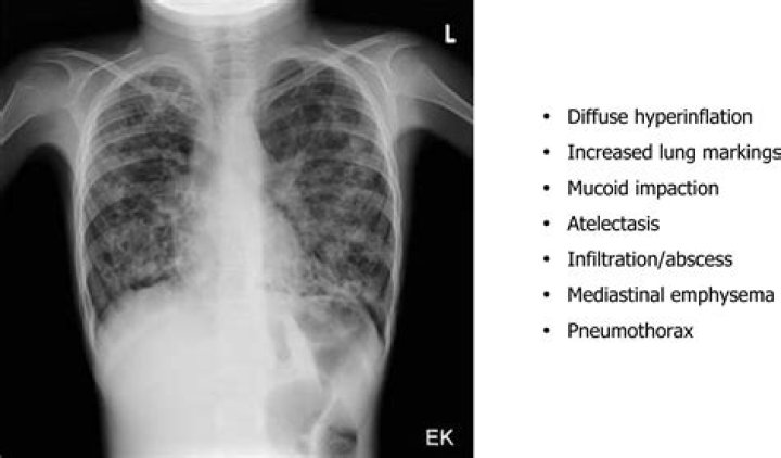 Why barrel chest in emphysema?