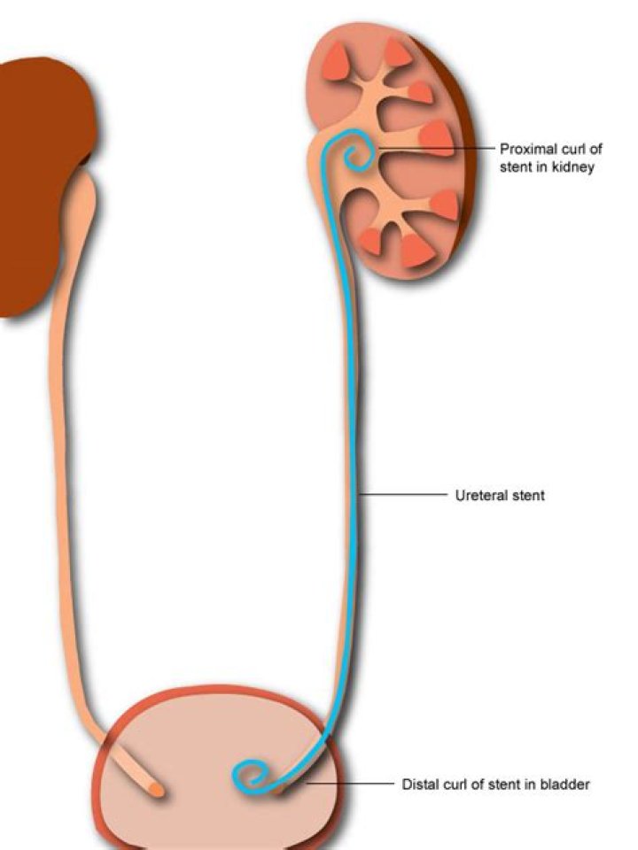 Why is a ureteral stent inserted?