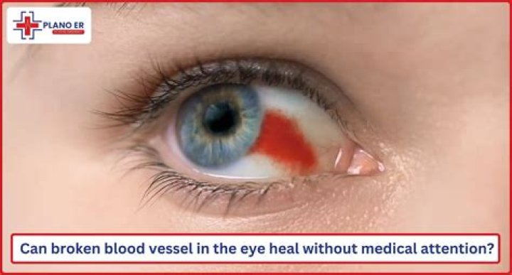 Will popped blood vessels heal?