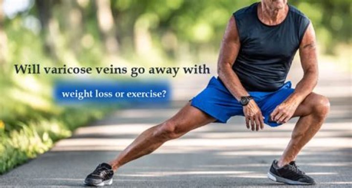 Will varicose veins go away with exercise?